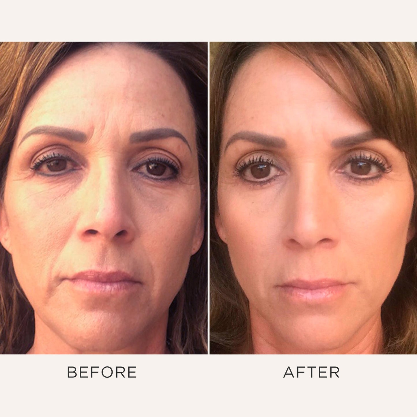 Fat Pad Restoration Bundle