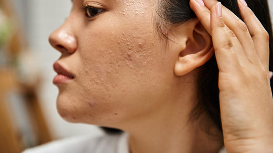 Breakthroughs in Acne: What Skin Mapping Reveals About the Root Cause