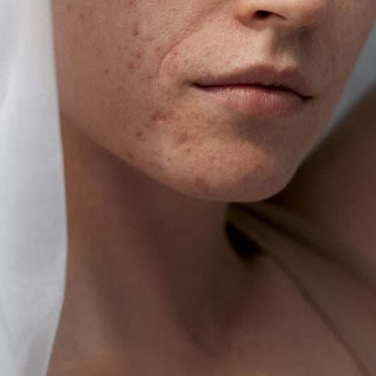 Peri-oral Dermatitis Bundle